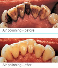 Air Polishing