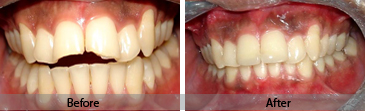 Composite Bonding