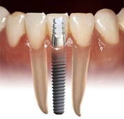 Benefits of dental impalants
