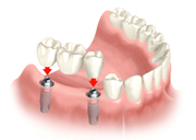 Replacement of Several Teeth