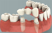 Fixed Dental Bridges