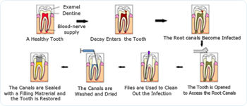 Necessity for root canal treatment