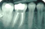 Root Canal Treatment