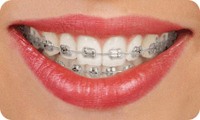 Teeth alignment