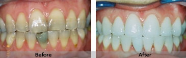 Tooth Whitening