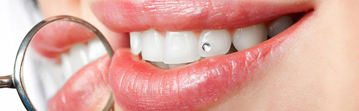 Dental Jewellery1