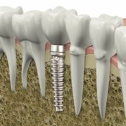 Implant Dentures in Trichy