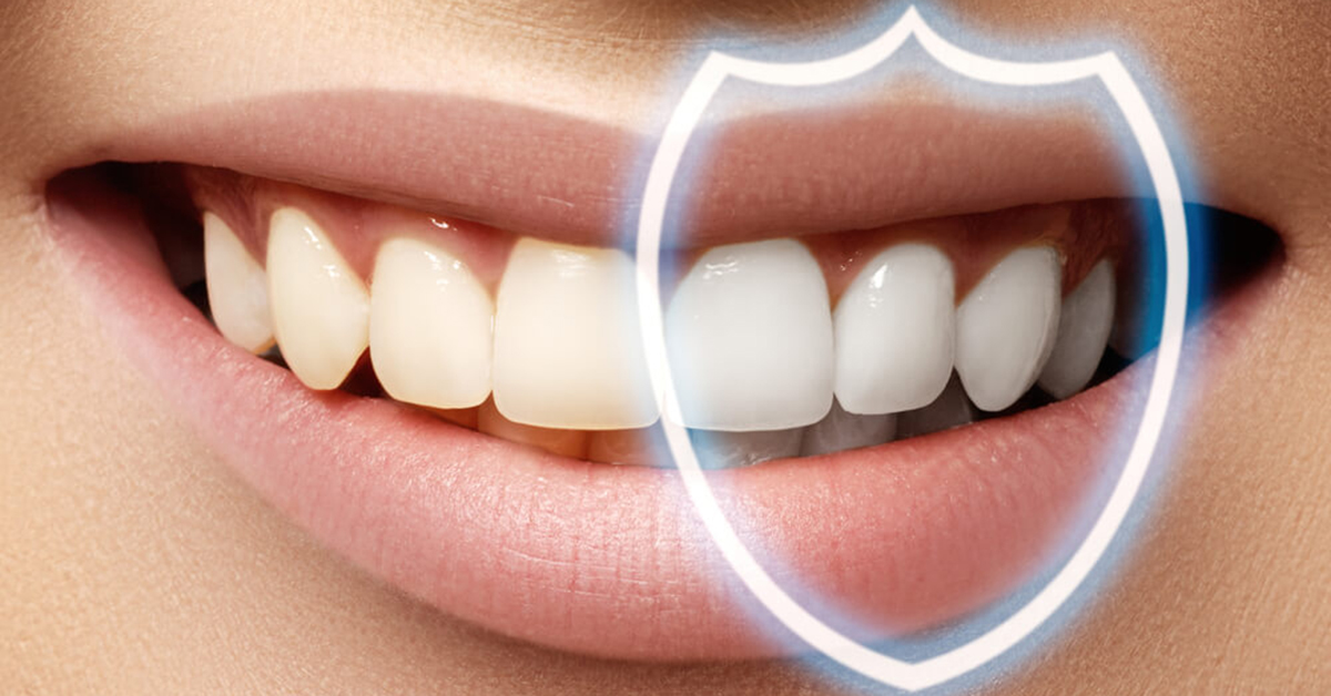 Bonded Teeth