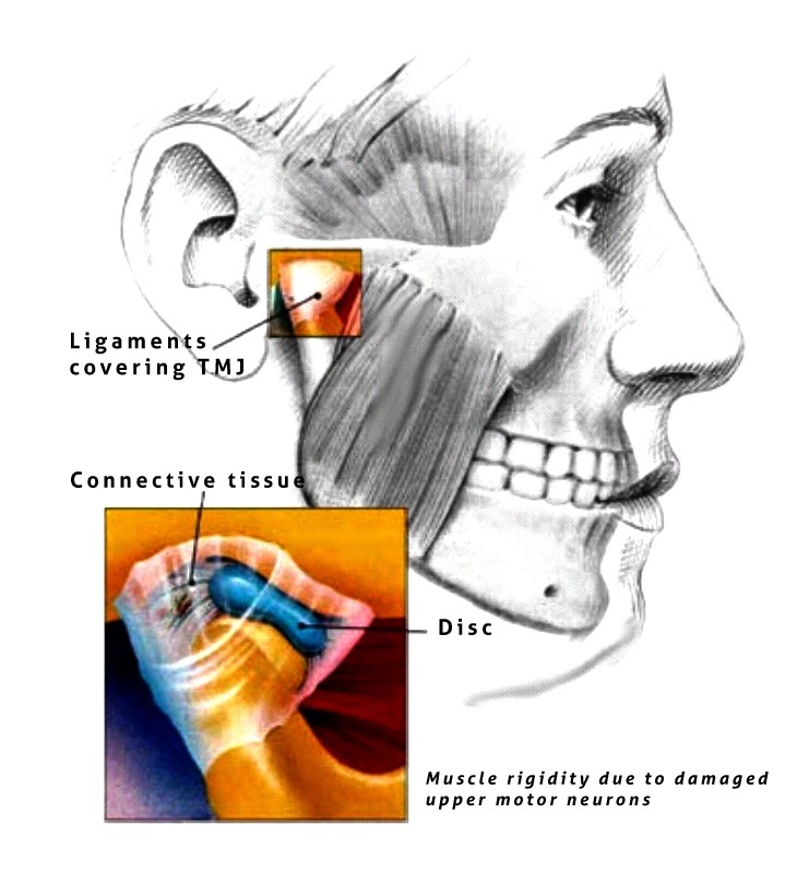 TMJ Disorder