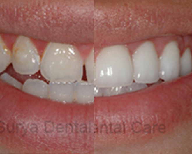 Our Smile Gallery