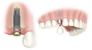 Replacement of Single Tooth