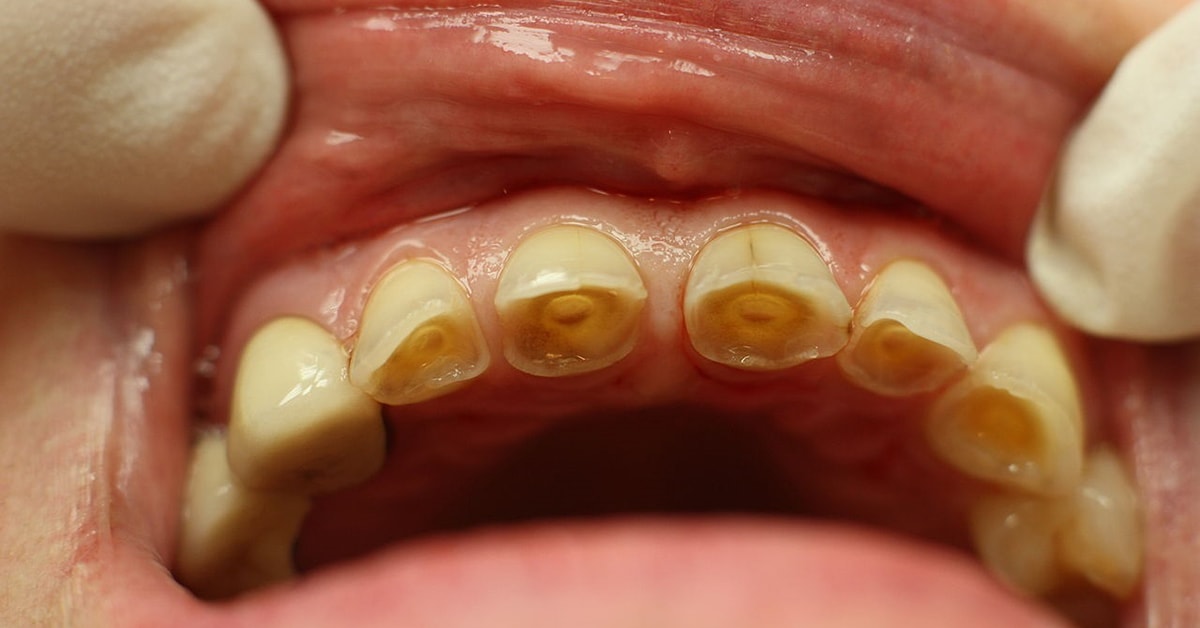 Tooth Enamel Erosion