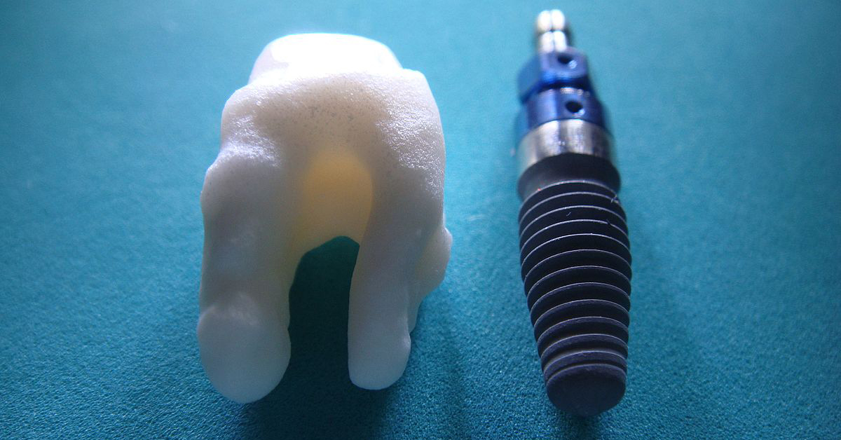 Important things you need to know about cleaning dental implants