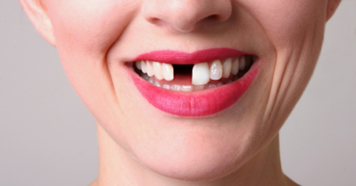 Hazards of Missing Tooth