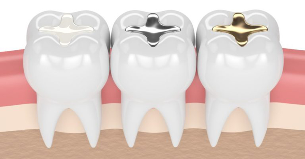 Different Types of Dental Filling materials brought by modern dentistry