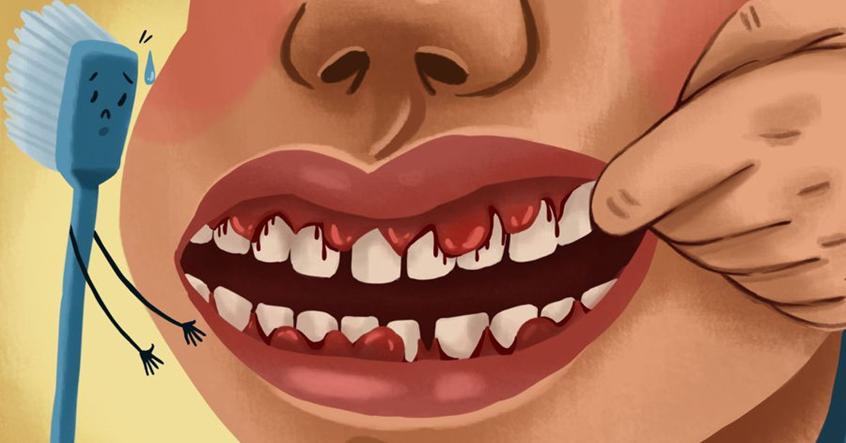 Bleeding Gums