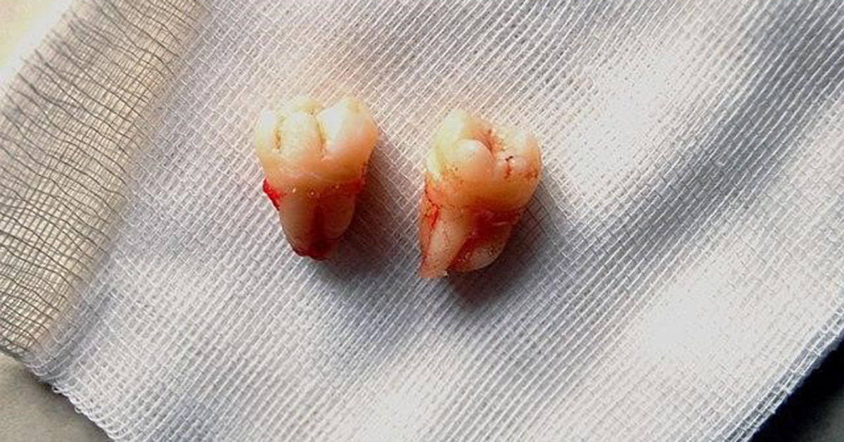 Tips to get relief from pain caused by Wisdom Teeth