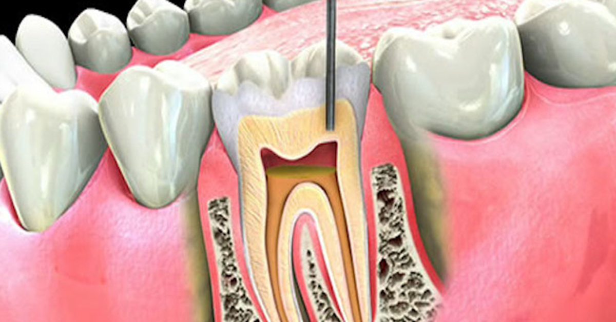 Few post care tips to be followed after root canal treatment