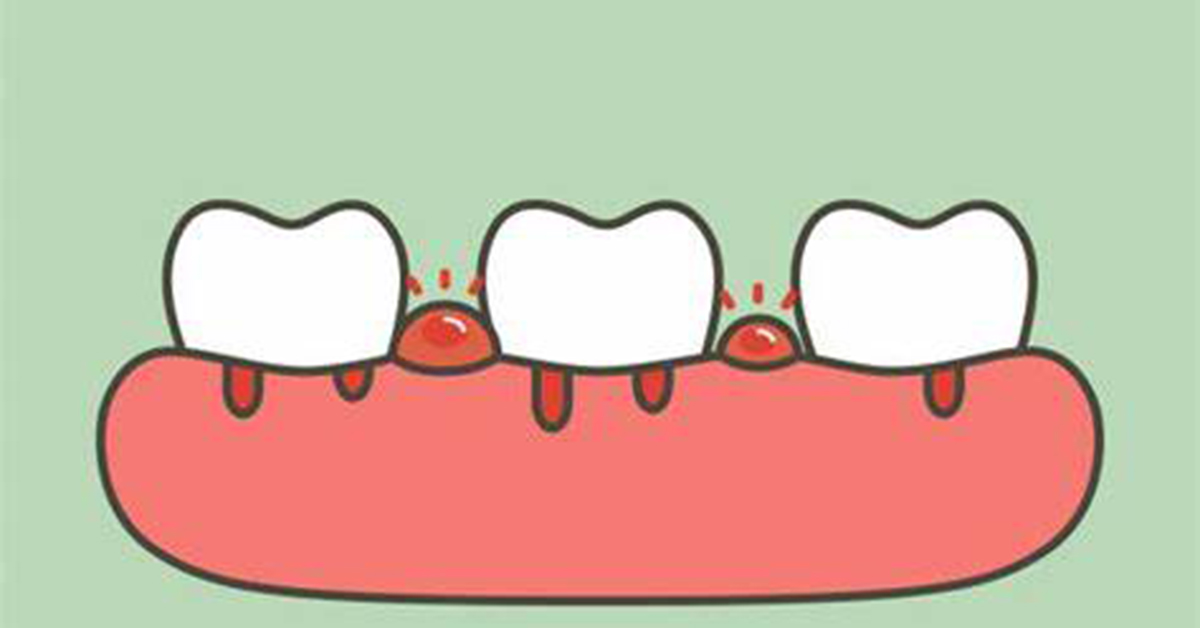 How to stop bleeding gums?