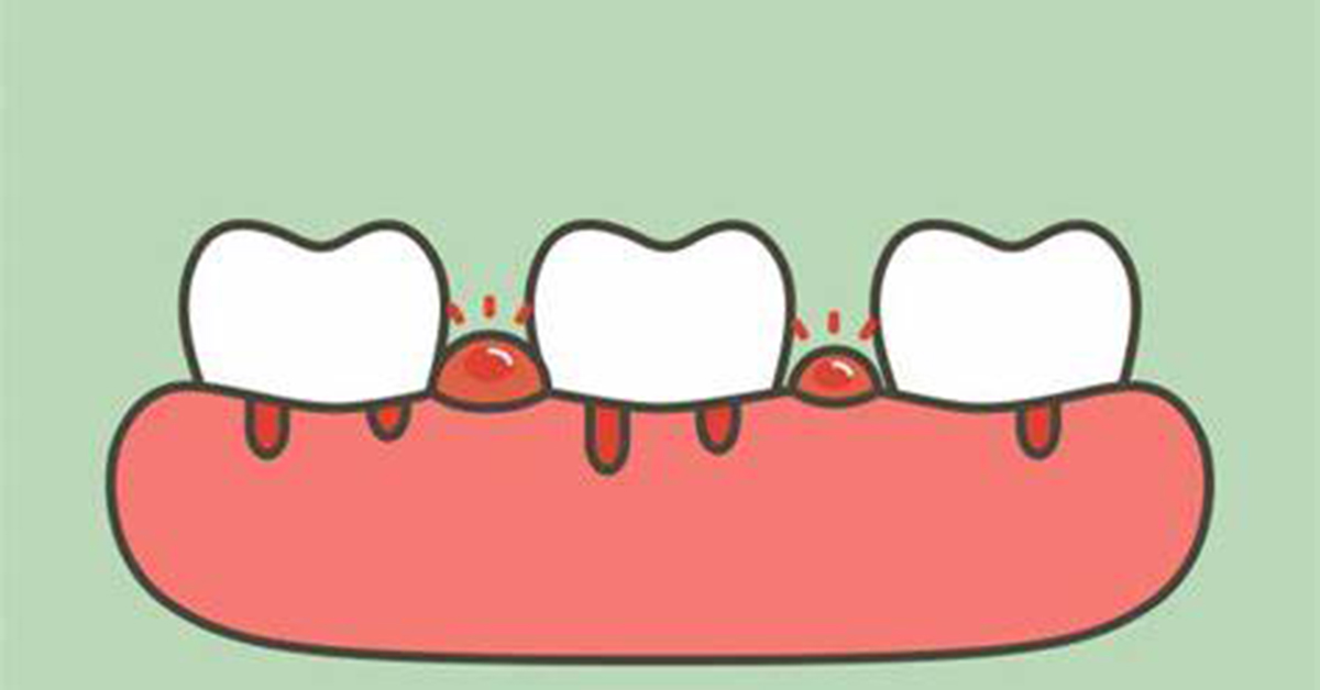 Bleeding Gums