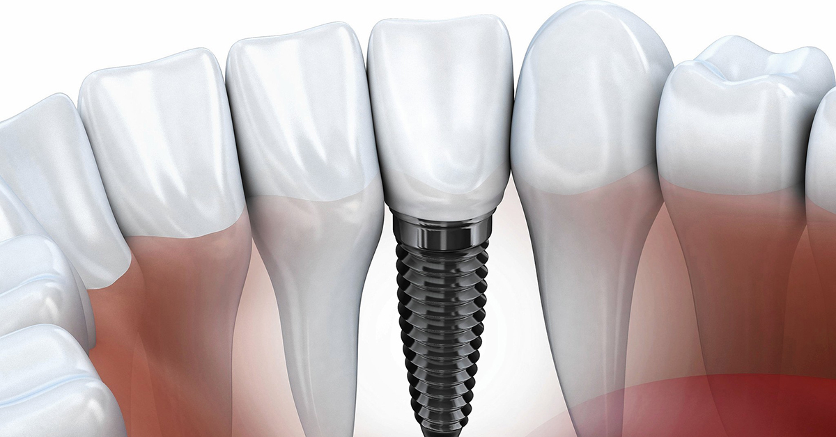 Dental Implants