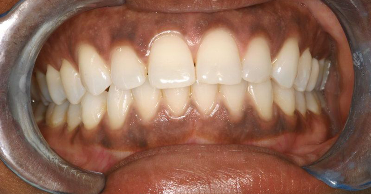 Black Colored Gums