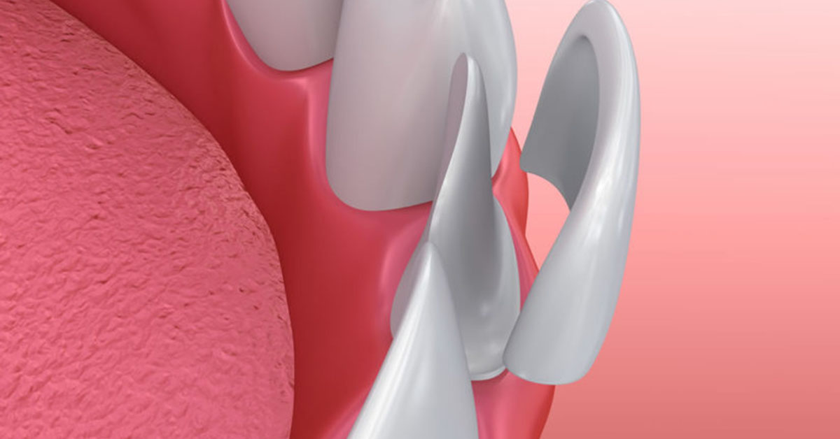 Dental Veneer