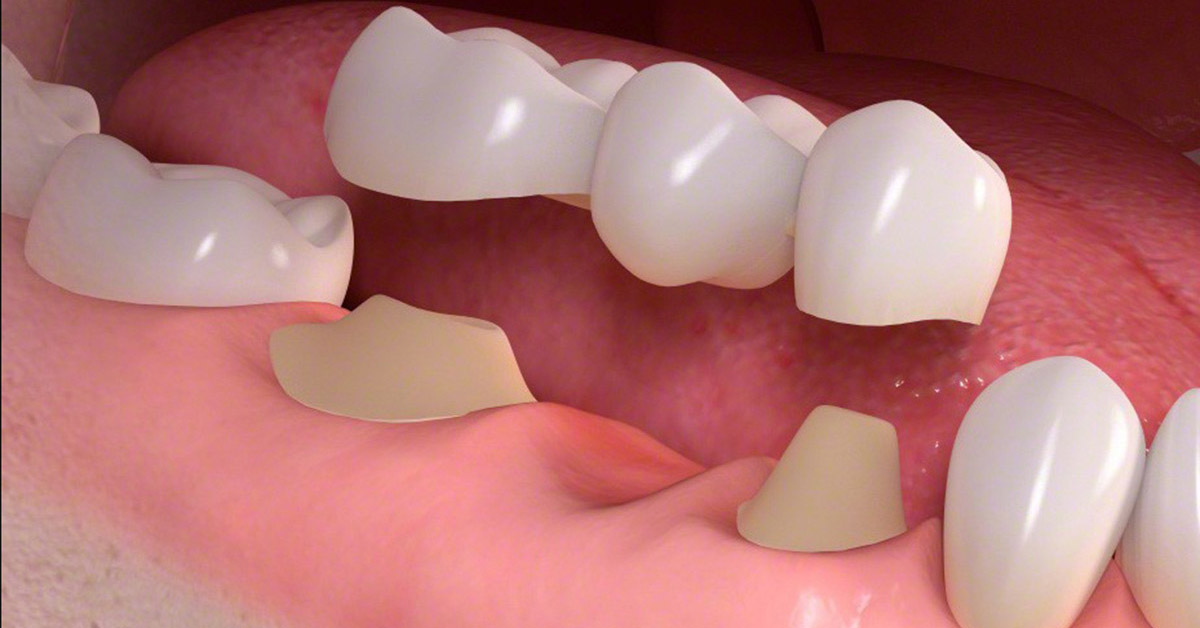 Tips to take care of Dental Bridges
