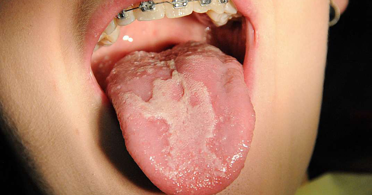 Geographic Tongue