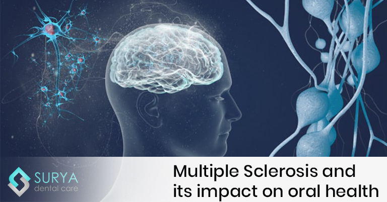 Multiple Sclerosis and its impact on oral health