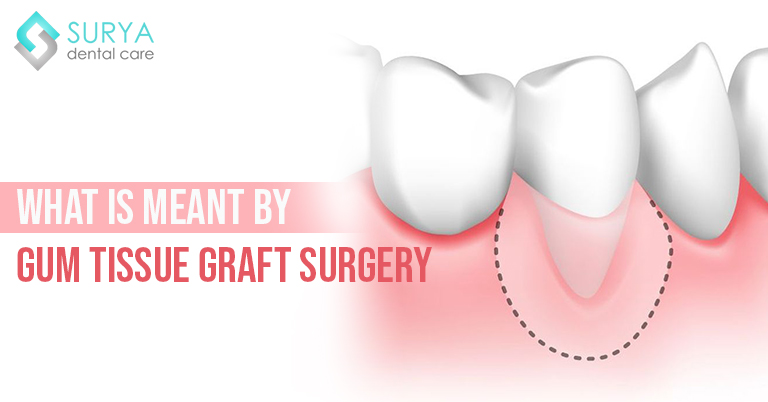 What is meant by Gum Tissue Graft Surgery
