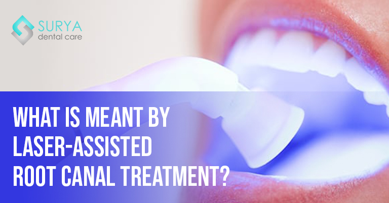 What is meant by Laser-Assisted Root Canal Treatment