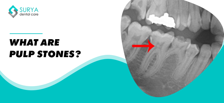 Pulp Stone – Causes, Types, and Removal