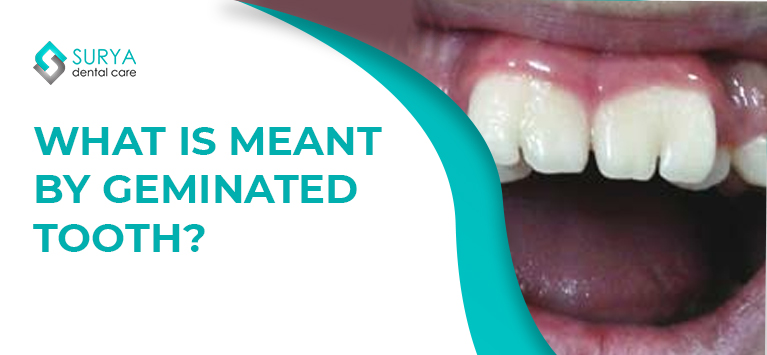 What is meant by Geminated tooth?