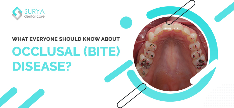 What everyone should know about Occlusal (Bite) Disease?