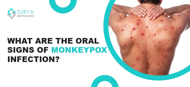 What are the oral signs of monkeypox infection?