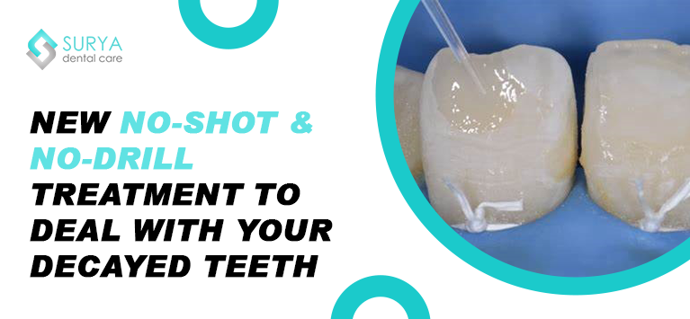 New no-shot & no-drill treatment to deal with your decayed teeth