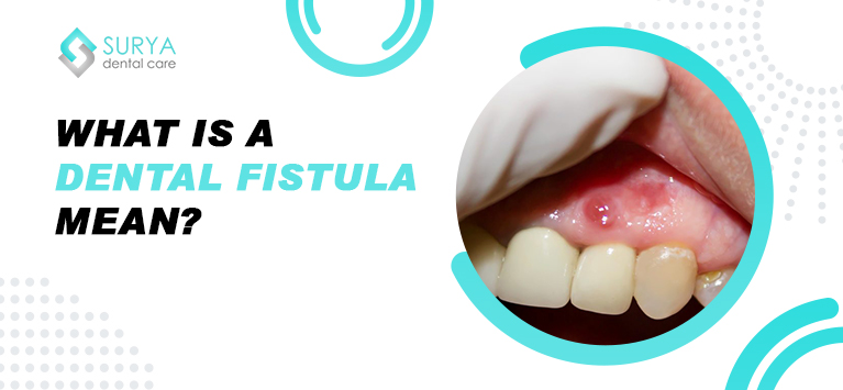 What is a dental fistula mean?