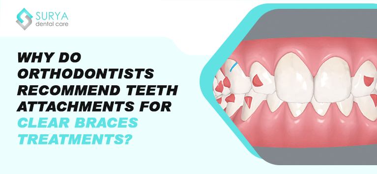 Why do Orthodontists recommend teeth attachments for clear braces treatments?