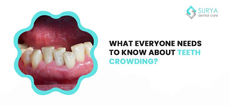 What everyone needs to know about teeth crowding?