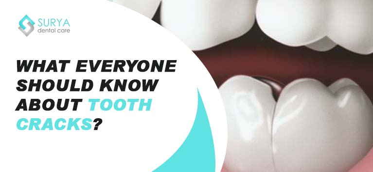 What everyone should know about tooth cracks?