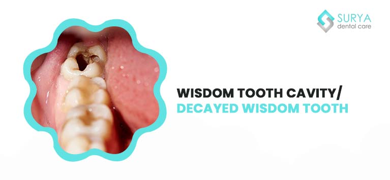 wisdom tooth cavity | decayed wisdom tooth