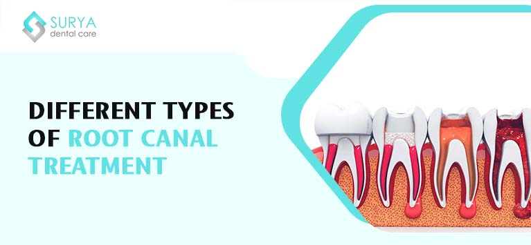 Different Types of Root Canal Treatment